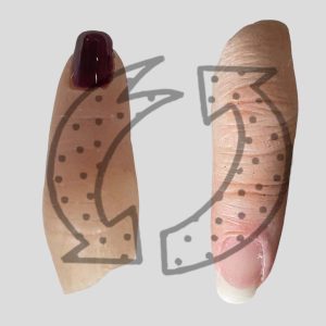 Szilikon ujjprotézis cseréje, felírása támogatással